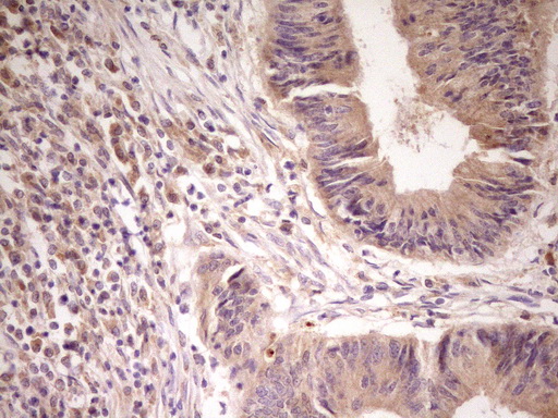 ACVR2 / ACVR2A Antibody - Immunohistochemical staining of paraffin-embedded Adenocarcinoma of Human colon tissue using anti-ACVR2A mouse monoclonal antibody. (Heat-induced epitope retrieval by 1 mM EDTA in 10mM Tris, pH8.5, 120C for 3min,