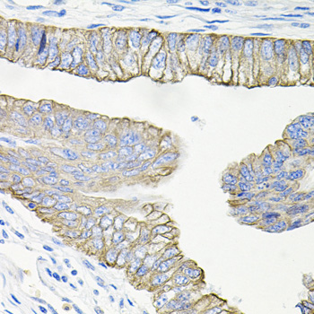 ACVR2 / ACVR2A Antibody - Immunohistochemistry of paraffin-embedded human colon carcinoma tissue.