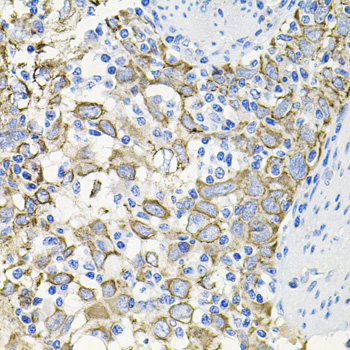 ACVR2 / ACVR2A Antibody - Immunohistochemistry of paraffin-embedded human esophageal cancer tissue.