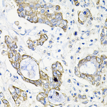 ACVR2 / ACVR2A Antibody - Immunohistochemistry of paraffin-embedded human gastric cancer tissue.
