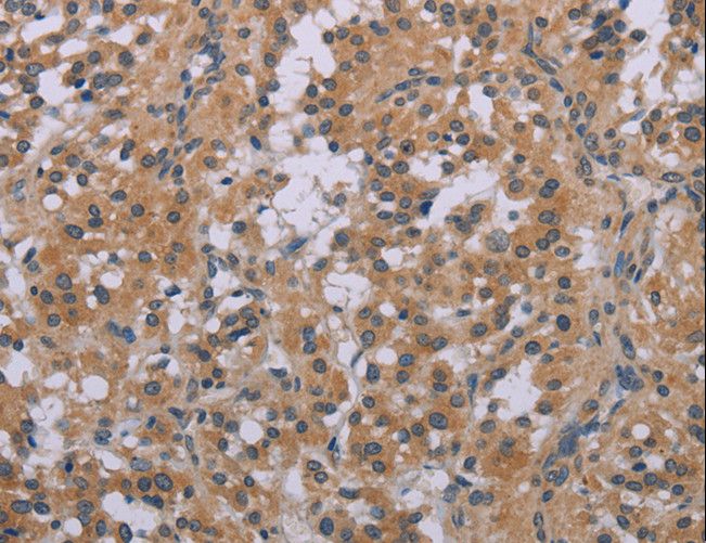 ACVR2 / ACVR2A Antibody - Immunohistochemistry of paraffin-embedded Human thyroid cancer using ACVR2A Polyclonal Antibody at dilution of 1:20.