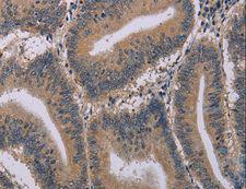 ACVR2 / ACVR2A Antibody - Immunohistochemistry of paraffin-embedded Human colon cancer using ACVR2A Polyclonal Antibody at dilution of 1:20.