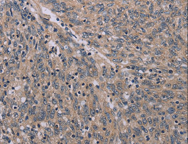 ACVR2 / ACVR2A Antibody - Immunohistochemistry of paraffin-embedded Human ovarian cancer using ACVR2A Polyclonal Antibody at dilution of 1:20.