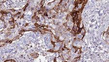 ACVR2 / ACVR2A Antibody - 1:100 staining human urothelial carcinoma tissue by IHC-P. The sample was formaldehyde fixed and a heat mediated antigen retrieval step in citrate buffer was performed. The sample was then blocked and incubated with the antibody for 1.5 hours at 22°C. An HRP conjugated goat anti-rabbit antibody was used as the secondary.