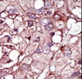 ACVRL1 Antibody - Formalin-fixed and paraffin-embedded human cancer tissue reacted with the primary antibody, which was peroxidase-conjugated to the secondary antibody, followed by DAB staining. This data demonstrates the use of this antibody for immunohistochemistry; clinical relevance has not been evaluated. BC = breast carcinoma; HC = hepatocarcinoma.