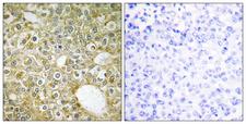 ACVRL1 Antibody - Peptide - + Immunohistochemistry analysis of paraffin-embedded human breast carcinoma tissue using ACVL1 antibody.