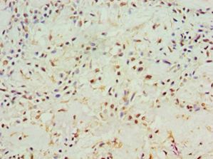 ACY1 / Aminoacylase 1 Antibody - Immunohistochemistry of paraffin-embedded human breast cancer using antibody at 1:100 dilution.
