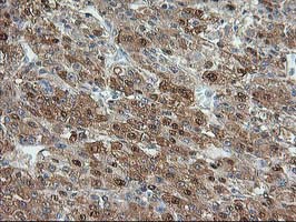 ACY1 / Aminoacylase 1 Antibody - IHC of paraffin-embedded Carcinoma of Human liver tissue using anti-ACY1 mouse monoclonal antibody. (Heat-induced epitope retrieval by 10mM citric buffer, pH6.0, 100C for 10min).