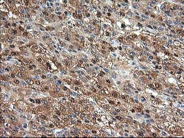 ACY1 / Aminoacylase 1 Antibody - IHC of paraffin-embedded Carcinoma of Human liver tissue using anti-ACY1 mouse monoclonal antibody.