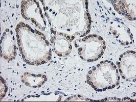 ACY1 / Aminoacylase 1 Antibody - IHC of paraffin-embedded Carcinoma of Human prostate tissue using anti-ACY1 mouse monoclonal antibody.