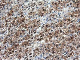 ACY1 / Aminoacylase 1 Antibody - IHC of paraffin-embedded Carcinoma of Human liver tissue using anti-ACY1 mouse monoclonal antibody.
