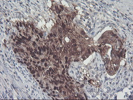 ACY1 / Aminoacylase 1 Antibody - IHC of paraffin-embedded Carcinoma of Human pancreas tissue using anti-ACY1 mouse monoclonal antibody.
