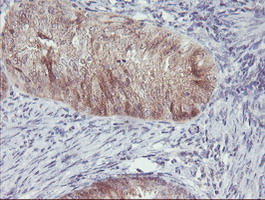 ACY1 / Aminoacylase 1 Antibody - IHC of paraffin-embedded Adenocarcinoma of Human endometrium tissue using anti-ACY1 mouse monoclonal antibody.