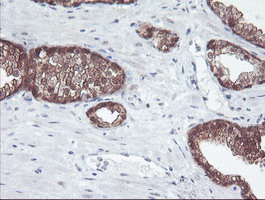 ACY1 / Aminoacylase 1 Antibody - IHC of paraffin-embedded Carcinoma of Human prostate tissue using anti-ACY1 mouse monoclonal antibody.