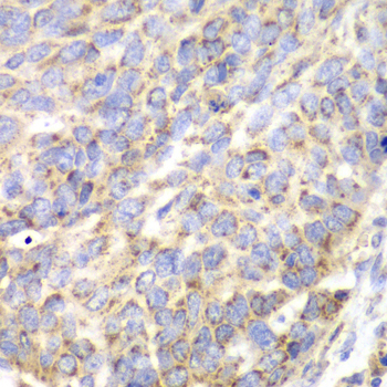ACY1 / Aminoacylase 1 Antibody - Immunohistochemistry of paraffin-embedded human esophageal cancer using ACY1 antibody at dilution of 1:100 (40x lens).