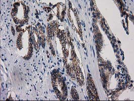 ACY3 Antibody - IHC of paraffin-embedded Carcinoma of Human prostate tissue using anti-ACY3 mouse monoclonal antibody.
