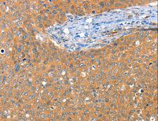 ACY3 Antibody - Immunohistochemistry of paraffin-embedded Human cervical cancer using ACY3 Polyclonal Antibody at dilution of 1:25.
