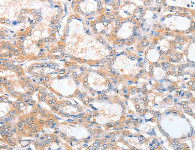 ACY3 Antibody - Immunohistochemistry of paraffin-embedded Human thyroid cancer using ACY3 Polyclonal Antibody at dilution of 1:25.