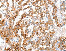 ACY3 Antibody - Immunohistochemistry of paraffin-embedded Human thyroid cancer using ACY3 Polyclonal Antibody at dilution of 1:35.