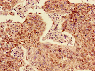 ACYP2 Antibody - Immunohistochemistry of paraffin-embedded human cervical cancer using ACYP2 Antibody at dilution of 1:100