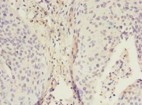 ADA / Adenosine Deaminase Antibody - Immunohistochemistry of paraffin-embedded human cervical cancer using antibody at 1:100 dilution.  This image was taken for the unconjugated form of this product. Other forms have not been tested.