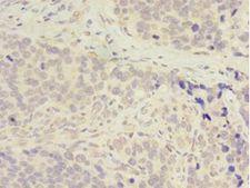ADA / Adenosine Deaminase Antibody - Immunohistochemistry of paraffin-embedded human gastric cancer using antibody at 1:100 dilution.  This image was taken for the unconjugated form of this product. Other forms have not been tested.