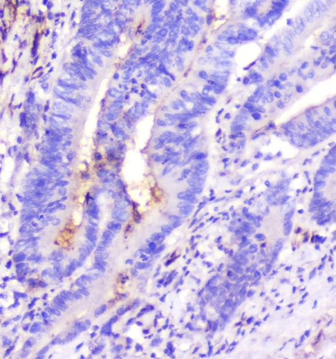 ADA / Adenosine Deaminase Antibody - IHC analysis of ADA using anti-ADA antibody. ADA was detected in paraffin-embedded section of human colon cancer tissue. Heat mediated antigen retrieval was performed in citrate buffer (pH6, epitope retrieval solution) for 20 mins. The tissue section was blocked with 10% goat serum. The tissue section was then incubated with 1µg/ml mouse anti-ADA Antibody overnight at 4°C. Biotinylated goat anti-mouse IgG was used as secondary antibody and incubated for 30 minutes at 37°C. The tissue section was developed using Strepavidin-Biotin-Complex (SABC) with DAB as the chromogen.