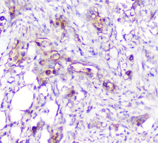 ADA / Adenosine Deaminase Antibody - IHC analysis of ADA using anti-ADA antibody. ADA was detected in paraffin-embedded section of human rectal cancer tissue. Heat mediated antigen retrieval was performed in citrate buffer (pH6, epitope retrieval solution) for 20 mins. The tissue section was blocked with 10% goat serum. The tissue section was then incubated with 1µg/ml mouse anti-ADA Antibody overnight at 4°C. Biotinylated goat anti-mouse IgG was used as secondary antibody and incubated for 30 minutes at 37°C. The tissue section was developed using Strepavidin-Biotin-Complex (SABC) with DAB as the chromogen.
