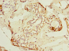 ADAD1 Antibody - Immunohistochemistry of paraffin-embedded human breast cancer at dilution 1:100