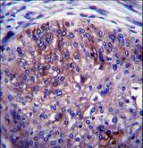 ADAL Antibody - ADAL Antibody immunohistochemistry of formalin-fixed and paraffin-embedded human esophagus carcinoma followed by peroxidase-conjugated secondary antibody and DAB staining.