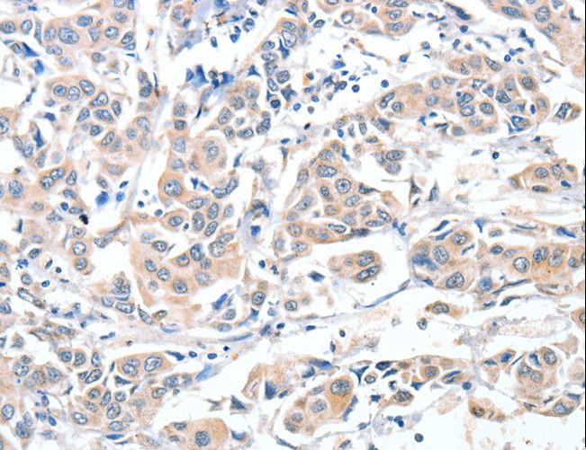 ADAM10 Antibody - Immunohistochemistry of paraffin-embedded Human breast cancer using ADAM10 Polyclonal Antibody at dilution of 1:30.