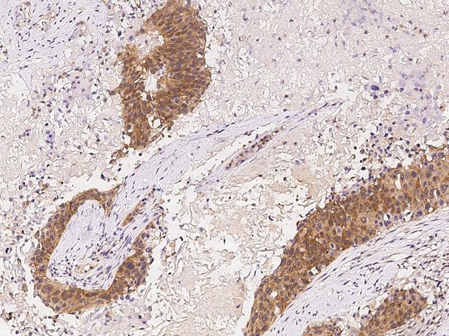 ADAM10 Antibody - Immunochemical staining of human ADAM10 in human lung cancer with rabbit polyclonal antibody at 1:100 dilution, formalin-fixed paraffin embedded sections.
