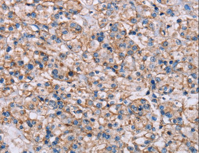 ADAM12 Antibody - Immunohistochemistry of paraffin-embedded Human prostate cancer using ADAM12 Polyclonal Antibody at dilution of 1:40.
