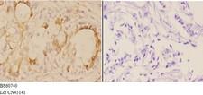ADAM12 Antibody - Immunohistochemistry (IHC) analysis of ADAM12 antibody in paraffin-embedded human breast carcinoma tissue at 1:50, showing cytoplasmic,membrane and nuclear staining. Negative control (the right) using PBS instead of primary antibody. Secondary antibody is Goat An.