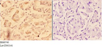 ADAM12 Antibody - Immunohistochemistry (IHC) analysis of ADAM12 antibody in paraffin-embedded human stomach carcinoma tissue at 1:50, showing cytoplasmic,membrane and nuclear staining. Negative control (the right) using PBS instead of primary antibody. Secondary antibody is Goat A.
