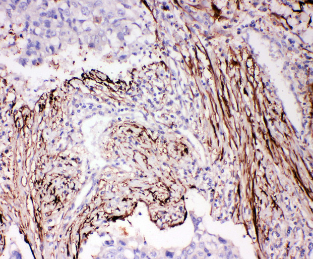 ADAM19 Antibody - ADAM19 antibody. IHC(P): Human Lung Cancer Tissue.