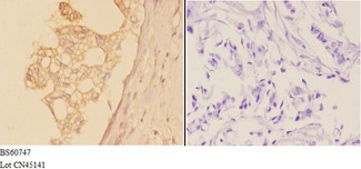 ADAM19 Antibody - Immunohistochemistry (IHC) analysis of ADAM19 antibody in paraffin-embedded human breast carcinoma tissue at 1:50, showing cytoplasmic and membrane staining. Negative control (the right) using PBS instead of primary antibody. Secondary antibody is Goat Anti-Rabbit IgG.