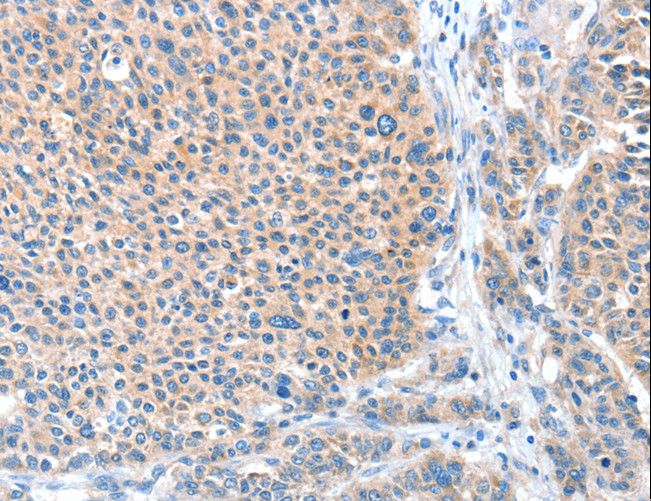 ADAM20 Antibody - Immunohistochemistry of paraffin-embedded Human liver cancer using ADAM20 Polyclonal Antibody at dilution of 1:50.