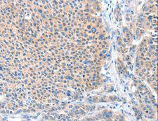 ADAM20 Antibody - Immunohistochemistry of paraffin-embedded Human liver cancer using ADAM20 Polyclonal Antibody at dilution of 1:50.