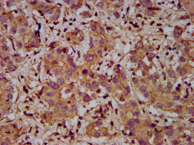 ADAM23 Antibody - Immunohistochemistry Dilution at 1:400 and staining in paraffin-embedded human liver cancer performed on a Leica BondTM system. After dewaxing and hydration, antigen retrieval was mediated by high pressure in a citrate buffer (pH 6.0). Section was blocked with 10% normal Goat serum 30min at RT. Then primary antibody (1% BSA) was incubated at 4°C overnight. The primary is detected by a biotinylated Secondary antibody and visualized using an HRP conjugated SP system.