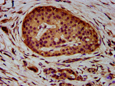 ADAM23 Antibody - Immunohistochemistry Dilution at 1:400 and staining in paraffin-embedded human pancreatic cancer performed on a Leica BondTM system. After dewaxing and hydration, antigen retrieval was mediated by high pressure in a citrate buffer (pH 6.0). Section was blocked with 10% normal Goat serum 30min at RT. Then primary antibody (1% BSA) was incubated at 4°C overnight. The primary is detected by a biotinylated Secondary antibody and visualized using an HRP conjugated SP system.