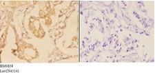 ADAM28 Antibody - Immunohistochemistry (IHC) analysis of ADAM28 antibody in paraffin-embedded human breast carcinoma tissue at 1:50, showing membrane and secreted staining. Negative control (the right) using PBS instead of primary antibody. Secondary antibody is Goat Anti-Rabbit I.