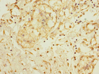 ADAM28 Antibody - Immunohistochemistry of paraffin-embedded human breast cancer at dilution 1:100