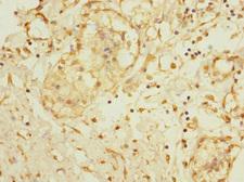 ADAM28 Antibody - Immunohistochemistry of paraffin-embedded human breast cancer at dilution 1:100