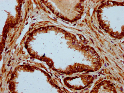 ADAM29 Antibody - Immunohistochemistry Dilution at 1:500 and staining in paraffin-embedded human prostate cancer performed on a Leica BondTM system. After dewaxing and hydration, antigen retrieval was mediated by high pressure in a citrate buffer (pH 6.0). Section was blocked with 10% normal Goat serum 30min at RT. Then primary antibody (1% BSA) was incubated at 4°C overnight. The primary is detected by a biotinylated Secondary antibody and visualized using an HRP conjugated SP system.