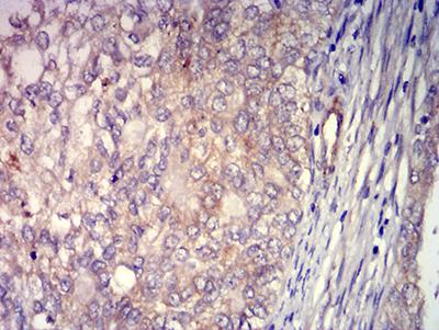 ADAM8 Antibody - Immunohistochemical analysis of paraffin-embedded cervical cancer tissues using CD156 mouse mAb with DAB staining.