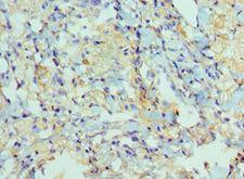 ADAM9 Antibody - Immunohistochemistry of paraffin-embedded human lung cancer using antibody at 1:100 dilution.