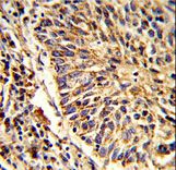 ADAM9 Antibody - Formalin-fixed and paraffin-embedded human lung carcinoma reacted with ADAM9 Antibody , which was peroxidase-conjugated to the secondary antibody, followed by DAB staining. This data demonstrates the use of this antibody for immunohistochemistry; clinical relevance has not been evaluated.