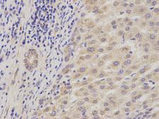 ADAM9 Antibody - Immunohistochemistry of paraffin-embedded human liver cancer using ADAM9 antibody at dilution of 1:200 (400x lens).