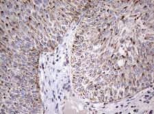 ADAMTS1 Antibody - Immunohistochemical staining of paraffin-embedded Carcinoma of Human bladder tissue using anti-ADAMTS1 mouse monoclonal antibody.  Dilution: 1:150